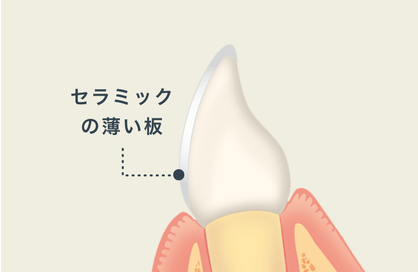 ラミネートベニア