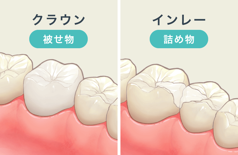 ジルコニア（クラウン／インレー）