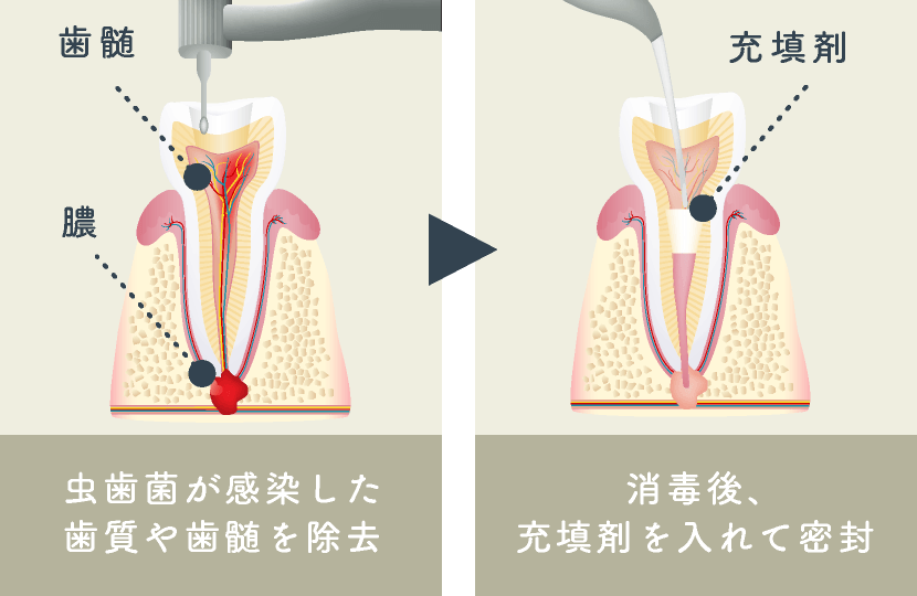 進行した虫歯(C3)の場合