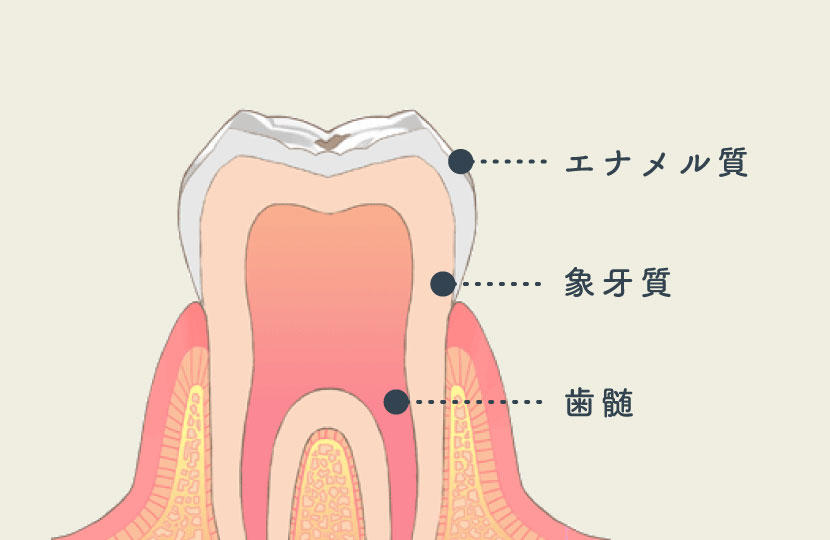 初期虫歯(CO)の場合