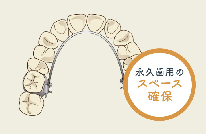 リンガルアーチ