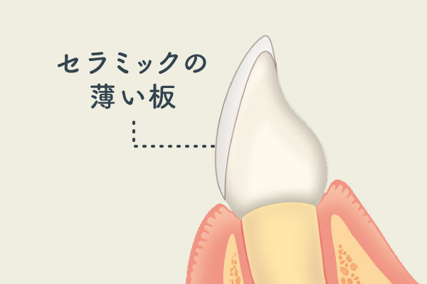 ラミネートベニア
